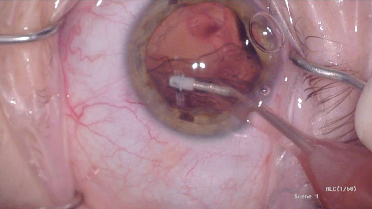 Standard cataract surgery with injection